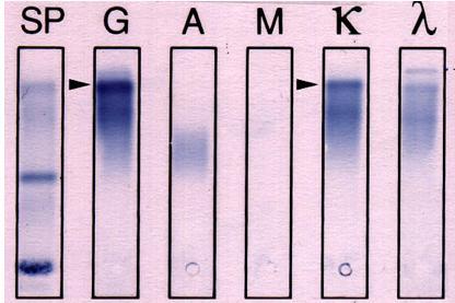 Immunofixation: after serum electrophoresis, each sample is overlaid with a different