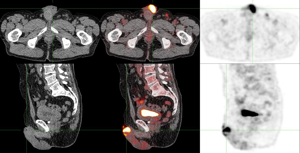 834 Ottenhof and Vegt. The role of PET/CT imaging in penile cancer Figure 1 FDG-PET/CT of a penile cancer patient. The primary tumor exhibits high FDG uptake (SUVmax 11.7).