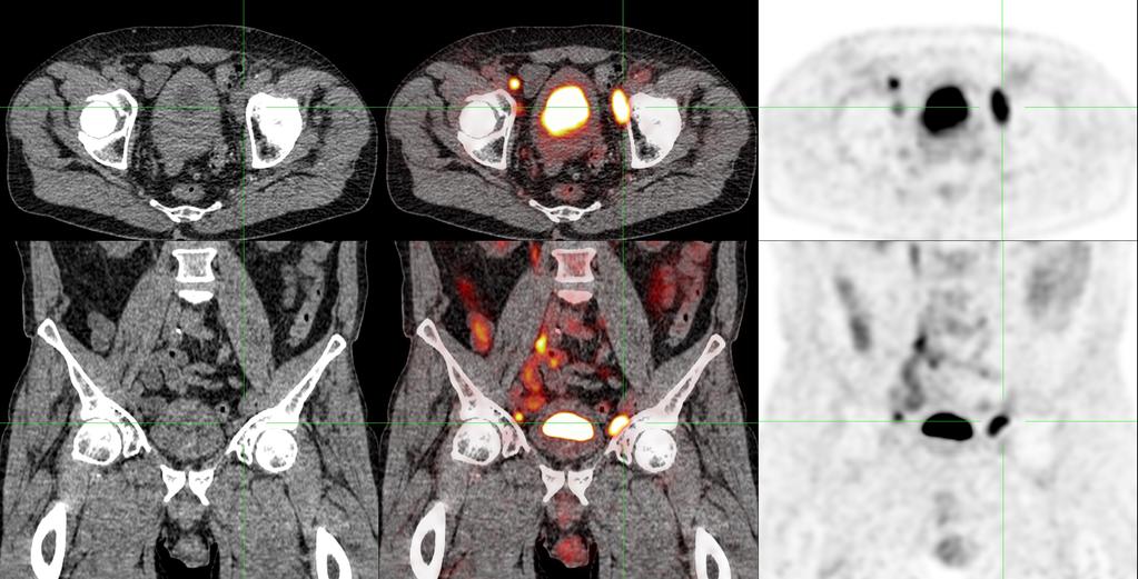 Translational Andrology and Urology, Vol 6, No 5 October 2017 835 Figure 2 FDG-PET/CT of the same penile cancer patient, who was clinically staged as positive for inguinal lymph node metastases (cn+).