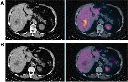 Response to therapy of liver met gastric GIST No morphological change in the metastasis CT PET/CT