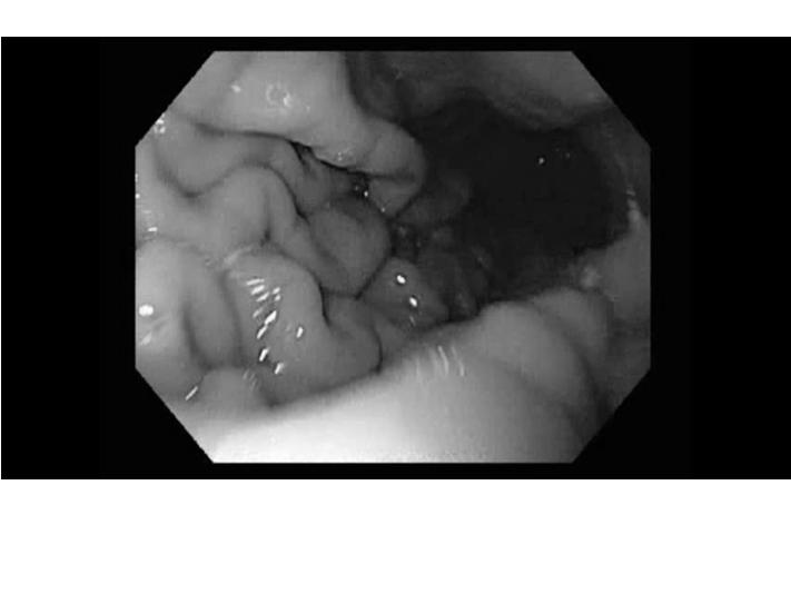 Digestive Endoscopy, 2012 Summary - Vascular malformations are been recognized more frequently as
