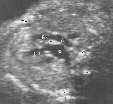 Fetal hydrops may occur if pulmonary venous return is obstructed.
