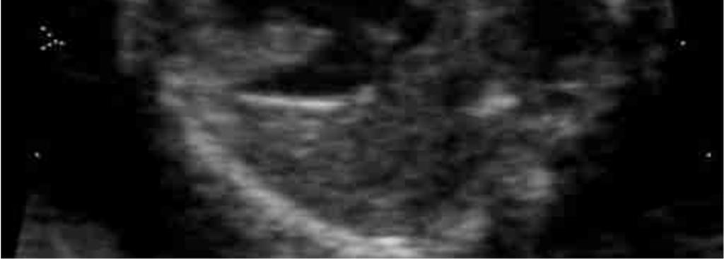 This anomaly accounts for 2% of live births with a congenital heart defect. [5] Because of its diverse morphology, DORV does not have a typical ultrasound appearance.