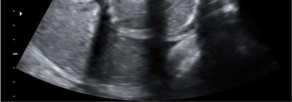 DISCUSSION Figure 3 and 4: Antenatal ultrasound images demonstrating two great vessels that do not cross but arise parallel from the base of the heart suggesting transposition of great