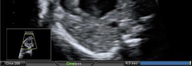 On M-mode fetal echocardiography, an abnormal oscillatory pattern of the foramen ovale flap motion was detected which gave us the clue to the existence of septum secundum type of