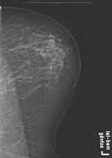 5 Mammography Other Noncontrast Diagnostic Studies 1 2 3 4 Criteria for a Good Radiographic View Mediolateral oblique: The pectoral muscle should appear as a triangle (with an angle of about 20 ) (1)