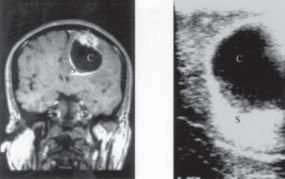 Figure 1: A 57-year-old-male with high-grade glial tumor (anaplastic astrocytoma).