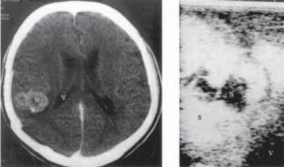 (B) Intraoperative ultrasonography shows compartmentalization of the necrotic part and solid area of the tumor.