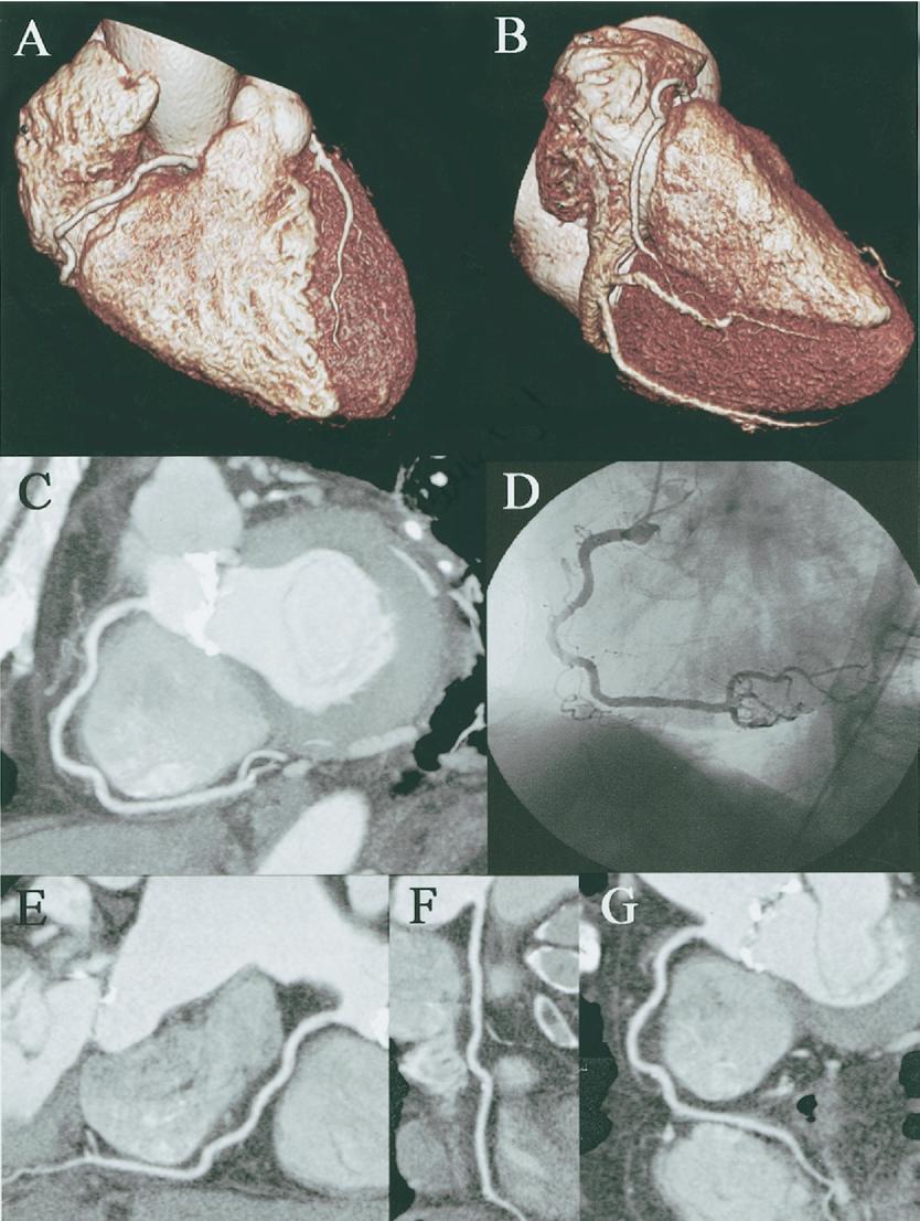 Meijboom et al. CT Coronary Angiography for Cardiac Valve Surgery JACC Vol. 48, No. 8, 2006 October 17, 2006:1658 65 1661 Figure 1.
