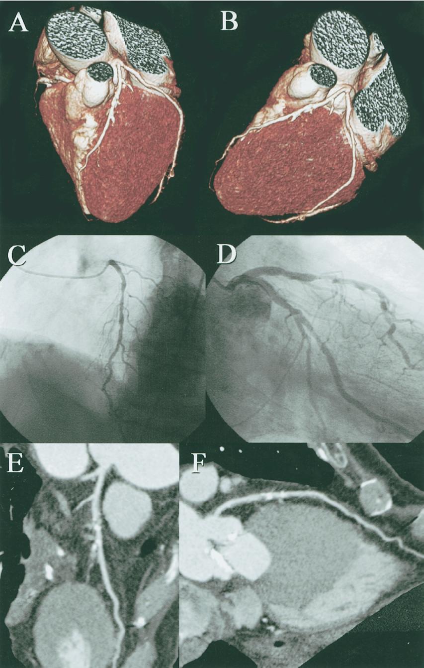 1662 Meijboom et al. CT Coronary Angiography for Cardiac Valve Surgery JACC Vol. 48, No. 8, 2006 October 17, 2006:1658 65 Figure 2.