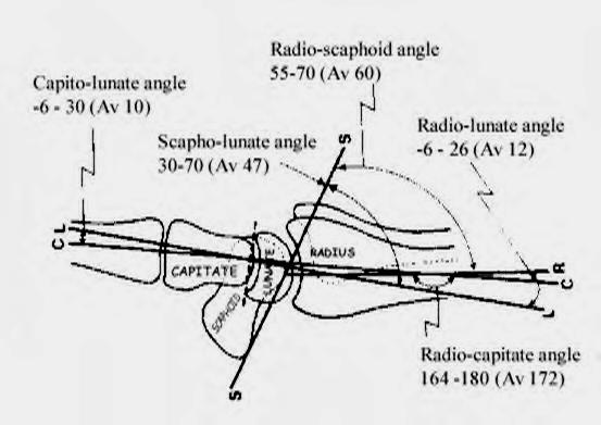 Type of instability A.Static Dissociate (intrinsic ligament) VISI [volar intercalated segmental instability] DISI [Dorsal intercalated segmental instability] B.