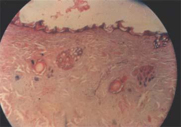 Histopathological changes 2 hours after thermal burn: The vescication of the upper layers of the epidermis is less evident because the spaces above the stratum germinativum and granulosum are reduced