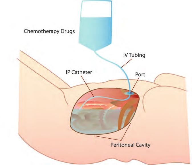 One dose of chemotherapy, some extra fluid for hydration, and anti-nausea drugs are given to you through an IV. The IP chemotherapy is given through tubing into a device called an IP port.