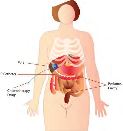 The Intraperitoneal (IP) Port What is an IP Port? An IP port is a round plastic and silicon disc that is surgically placed under your skin. It has a reservoir and a catheter.