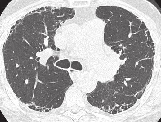 and, xial unenhanced chest CT images show peripheral- and