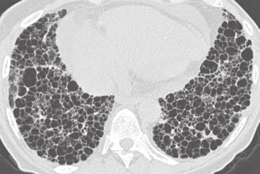 CT of Usual Interstitial Pneumonia Fig. 4 57-year-old woman with known connective tissue disease.