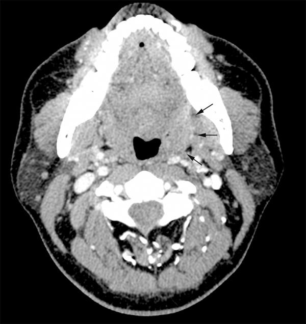 Discussion Figure 1. CT scan shows the contrast-enhancing mass originating from the left tonsil (arrows). Contrast-enhanced computed tomography (CT) scan of the neck showed a 3.4 1.