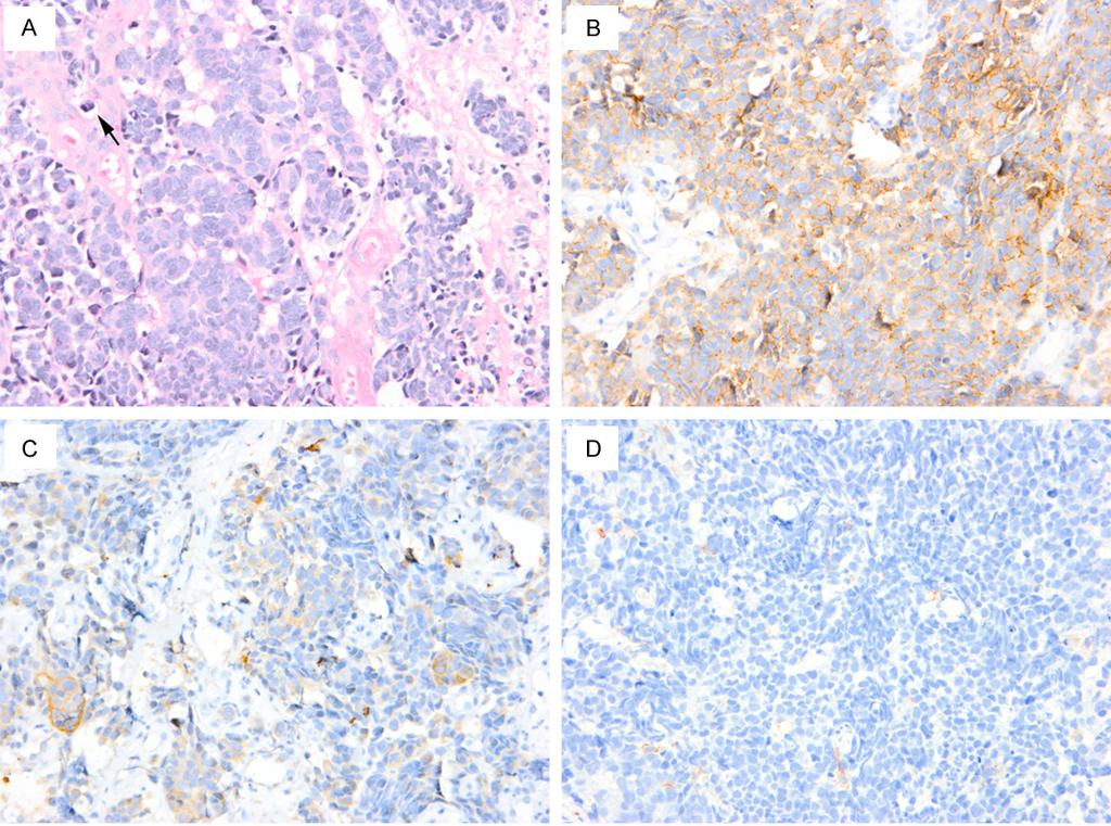 Figure 2. H. E. staining shows small round to oval tumor cells with scant cytoplasm, hyperchromatic nuclei and unobvious nucleoli. Mitoses (arrow) and necrosis are identified (A).
