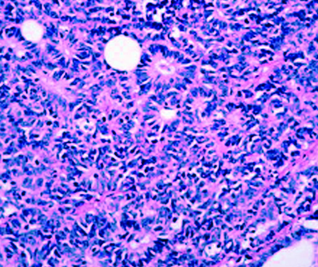 Alijo Serrano et al / NEUROENDOCRINE BLADDER CARCINOMA A B C D E Image 1 A, Section of small cell bladder carcinoma showing rosette formation (H&E, original magnification 20).