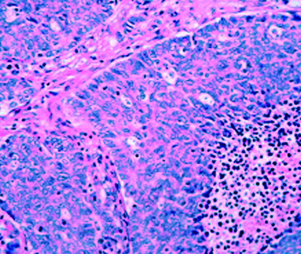 Large tumor cells have abundant cytoplasm with large nuclei, vesicular nuclear chromatin, and prominent nucleoli. No glandular or squamous differentiation is seen (H&E, original magnification 20).