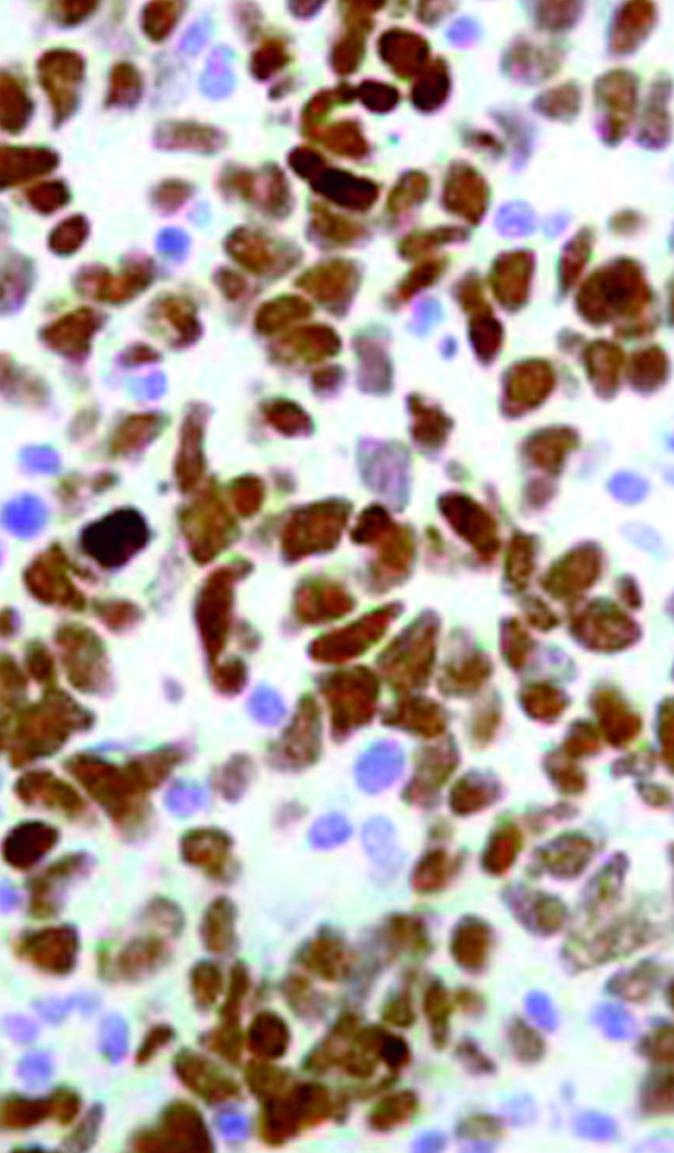 D, Immunostaining for surfactant protein A in the urothelial component (original magnification 10).