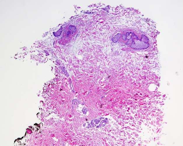 231 232 233 234 Figure 2: (A) Punch biopsy specimen of skin H & E stain of epidermis 235 demonstrating