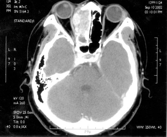 Computed tomography revealing a mass in the ethmoid sinus with extension into the medial aspect of right orbit.