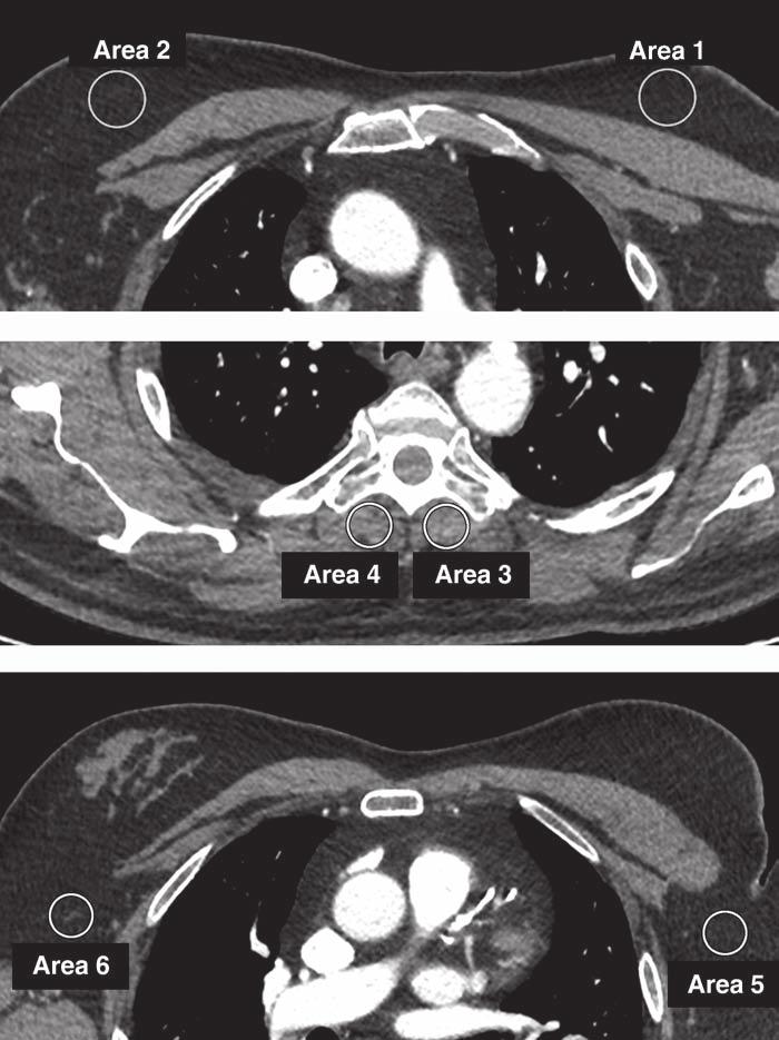 Three Algorithms to Assess Standard- and Low-Dose Chest CT Fig. 2 Measurements of region of interests (ROIs) for objective analysis. Six areas were measured with circular ROIs.