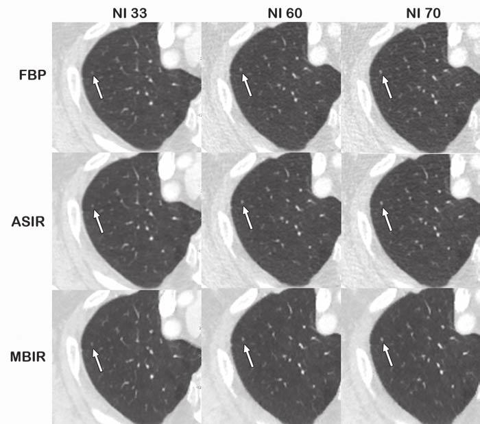 Three Algorithms to Assess Standard- and Low-Dose Chest CT TABLE 2: Diagnostic Acceptability Filtered Back Projection at Lesion Noise Index Lung nodule (n = 24) 100 100 100 100 Soft-tissue lesion (n