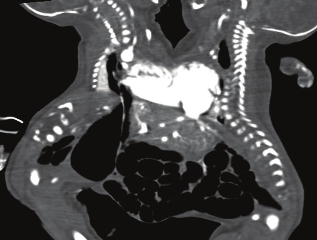 Case Reports in Radiology 3 Severe kyphoscoliosis Midline heart with crosscirculation Blind sac of oesophageal atresia Twin A Small bowel herniates at midline Twin B Figure 2: Virtual Reality