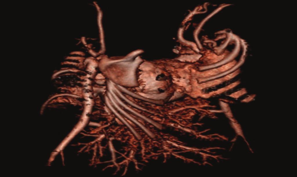 4 Case Reports in Radiology VRT showed the complex heart fusion Abdominal aorta Figure 4: 3D image of the cardiac fusion in twins A and B.