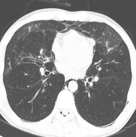Patchy ground-glass opacities (GGO) along the bronchovascular bundles are also noted in both lungs. B-D.