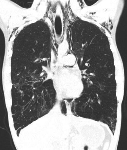 Multifocal patchy GGOs, bronchiectasis, as well as a mosaic pattern of attenuations mixed with paucity of regional