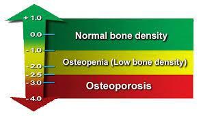 Leading cause of VCF is osteoporosis Risk of VCF