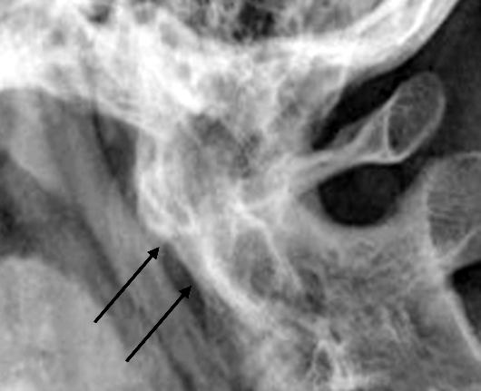Jeong Hoon Lee et al. Figure 1. (A) A 31-year-old ankylosing spondylitis patient with duration of 9 years.