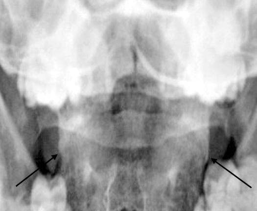 (B) A lateral radiograph of the cervical spine with full flexion of the same patient shows bony ankylosis of the atlantoaxial joint space and ankylosis of anterior longitudinal ligament (arrows,