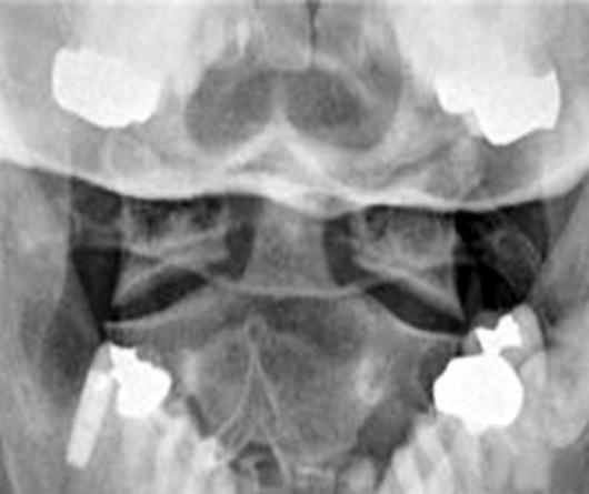 (B) A lateral radiograph of the cervical spine with full flexion of the same patient shows ankylosis of anterior longitudinal ligament (arrow, component III).