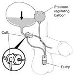 Surgical Treatments for Women with Stress Urinary Incontinence Artificial sphincter When the man uses the pump, the fluid in the balloon is transferred to the cuff of the artificial sphincter.