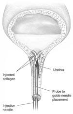 Burch suspension for urinary incontinence Surgery for stress urinary incontinence in women is usually very successful, but choosing the proper procedure is important.