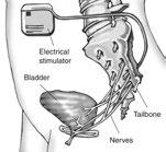 What Can I Expect After Treatment? A device can be placed under your skin to deliver mild electrical pulses to the nerves that control bladder function. nerve that controls bladder function.