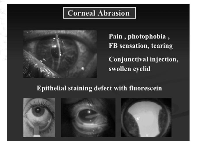 conjuctivalinjection with corneal