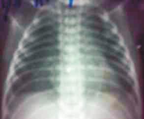 of airtrapping Pulmonary interstial emphysema (PIE)