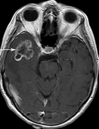 T1- weighted axial MR image of brain after administration of IV gadolinium () shows heterogeneous enhancement in both metastatic lesions. Fig.