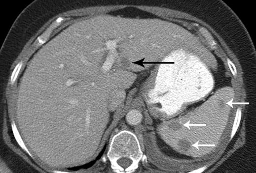 , xial CT section of chest shows left pleural effusion (P) and nodular pleural thickening, consistent with pleural