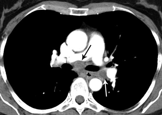 , xial CT section through mediastinum shows enlarged subcarinal (white arrow) and left hilar (black arrow) nodes,