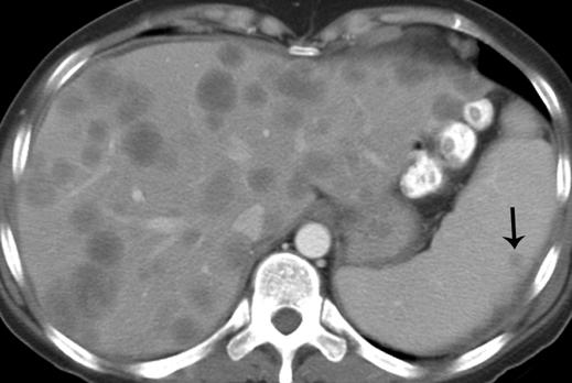 The liver is the most common site of solid organ metastases in the abdomen (Figs.