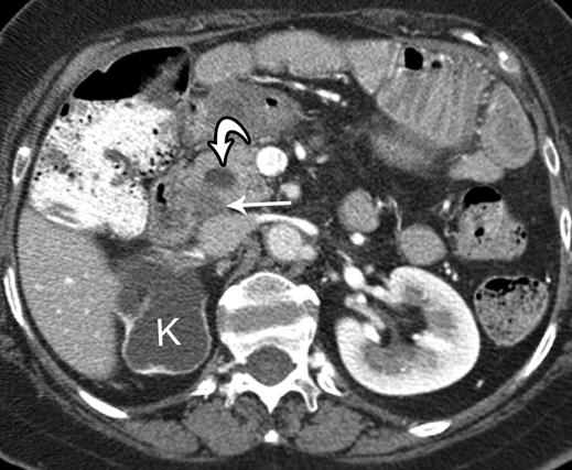 Isolated splenic metastasis can occur with ovarian cancer, unlike gastrointestinal tumors, although the spleen is still a rare site for recurrent ovarian cancer.