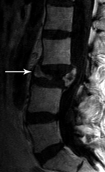 High T1 signal anterior to the spine is compatible with prevertebral fat.