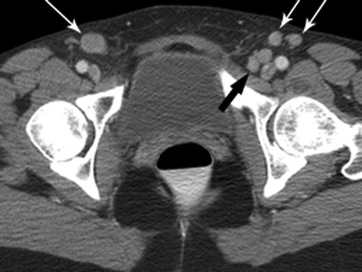 Osseous metastases may manifest as destructive lesions on conventional radiographs; they are associated with a soft-tissue mass on CT and MRI.