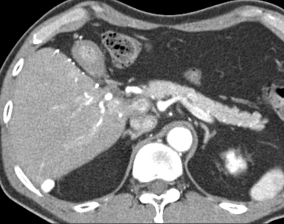 Contrast-enhanced arterial-phase axial CT image of the liver one month after transcatheter arterial chemoembolization